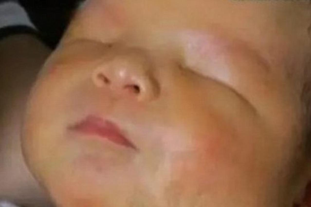 IZUZETNO RIJEDAK POREMEĆAJ