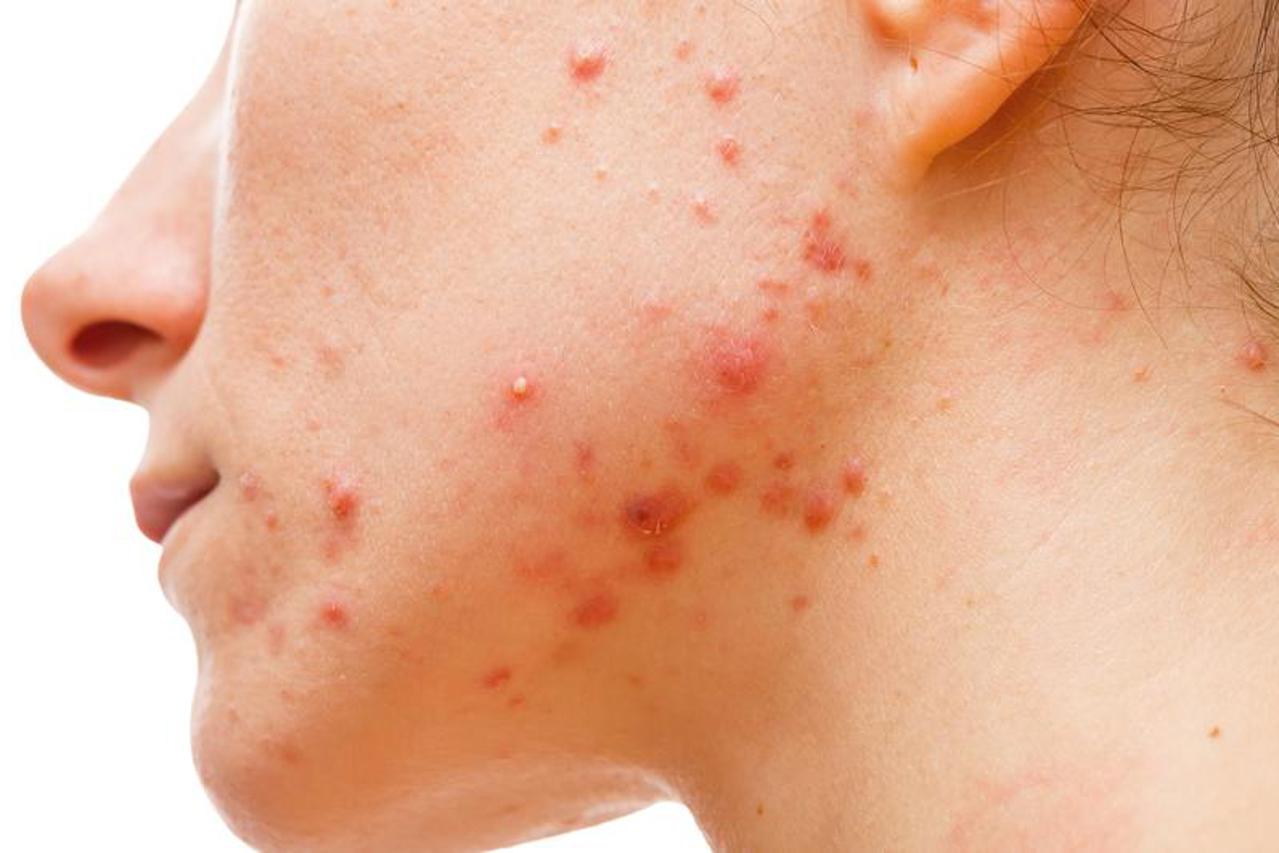 akne