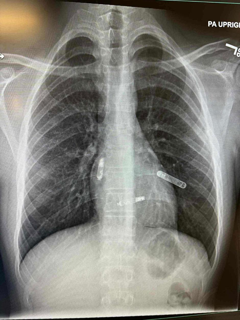 Dr. Svjetlana Tišma-Dupanović operacija srca